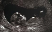 first trimester ultrasound.