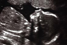 second trimester ultrasound.